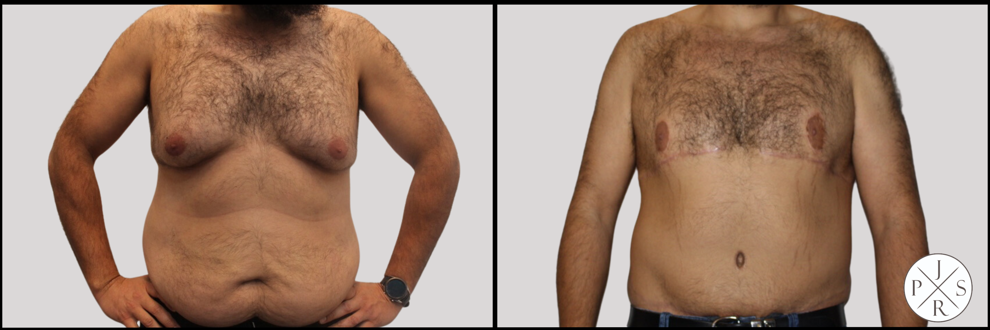 Abdominoplasty Before & After Image